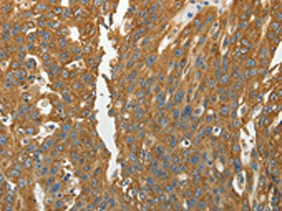 The image on the left is immunohistochemistry of paraffin-embedded Human ovarian cancer tissue using RPLP0 Antibody(RPLP0 Antibody) at dilution 1/40, on the right is treated with fusion protein. (Original magnification: ×200)Rabbit anti-Human RPLP0 Polyclonal Antibody
