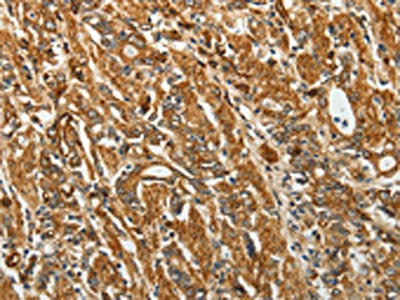 The image on the left is immunohistochemistry of paraffin-embedded Human gastic cancer tissue using the antibody Antibody) at dilution 1/40, on the right is treated with fusion protein. (Original magnification: ×200)Rabbit anti-Human RPLP0 Polyclonal Antibody