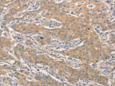 The image on the left is immunohistochemistry of paraffin-embedded Human gastric cancer tissue using NFE2L1 Antibody(NFE2L1 Antibody) at dilution 1/30, on the right is treated with fusion protein. (Original magnification: ×200)Rabbit anti-Human NFE2L1 Polyclonal Antibody