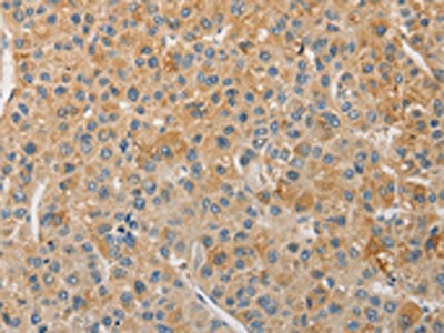 The image on the left is immunohistochemistry of paraffin-embedded Human liver cancer tissue using the antibody Antibody) at dilution 1/30, on the right is treated with fusion protein. (Original magnification: ×200)Rabbit anti-Human NFE2L1 Polyclonal Antibody