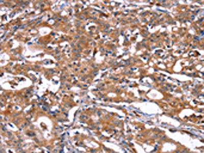 The image on the left is immunohistochemistry of paraffin-embedded Human gastric cancer tissue using HSD17B1 Antibody(HSD17B1 Antibody) at dilution 1/40, on the right is treated with synthetic peptide. (Original magnification: ×200)