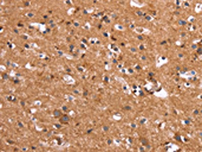 The image on the left is immunohistochemistry of paraffin-embedded Human brain tissue using the antibody Antibody) at dilution 1/40, on the right is treated with synthetic peptide. (Original magnification: ×200)