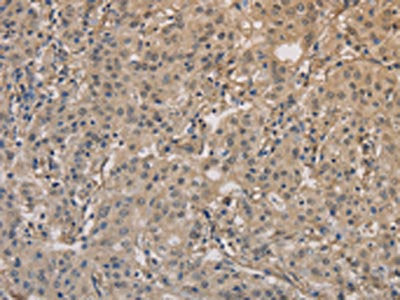 The image on the left is immunohistochemistry of paraffin-embedded Human gastric cancer tissue using DPYSL3 Antibody(DPYSL3 Antibody) at dilution 1/20, on the right is treated with fusion protein. (Original magnification: ×200)Rabbit anti-Human DPYSL3 Polyclonal Antibody
