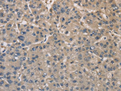 The image on the left is immunohistochemistry of paraffin-embedded Human liver cancer tissue using the antibody Antibody) at dilution 1/20, on the right is treated with fusion protein. (Original magnification: ×200)Rabbit anti-Human DPYSL3 Polyclonal Antibody