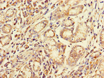 Immunohistochemistry of paraffin-embedded human gastric cancer using FCGR2A Antibody at dilution of 1:100Rabbit anti-Human FCGR2A Polyclonal Antibody