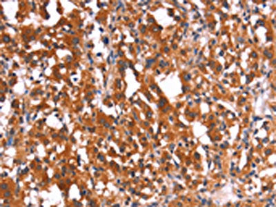 The image on the left is immunohistochemistry of paraffin-embedded Human thyroid cancer tissue using HMGCS2 Antibody(HMGCS2 Antibody) at dilution 1/40, on the right is treated with synthetic peptide. (Original magnification: ×200)Rabbit anti-Human HMGCS2 Polyclonal Antibody