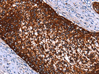 The image on the left is immunohistochemistry of paraffin-embedded Human cervical cancer tissue using the antibody Antibody) at dilution 1/40, on the right is treated with synthetic peptide. (Original magnification: ×200)Rabbit anti-Human HMGCS2 Polyclonal Antibody