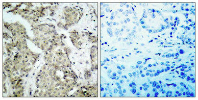 Immunohistochemical analysis of paraffin- embedded human breast carcinoma tissue using MKK6(Phospho-Ser207) Antibody(left) or the same antibody preincubated with blocking peptide(right).
