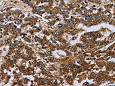 The image on the left is immunohistochemistry of paraffin-embedded Human liver cancer tissue using the antibody Antibody) at dilution 1/30, on the right is treated with fusion protein. (Original magnification: ×200)Rabbit anti-Human FH Polyclonal Antibody
