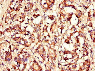 Immunohistochemistry of paraffin-embedded human gastric cancer using LASP1 Antibody at dilution of 1:100
