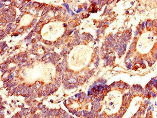Immunohistochemistry of paraffin-embedded human colon cancer using LASP1 Antibody at dilution of 1:100
