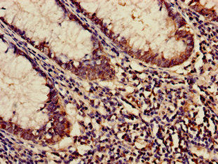 Immunohistochemistry of paraffin-embedded human colon cancer using KARS Antibody at dilution of 1:100