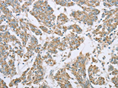 The image on the left is immunohistochemistry of paraffin-embedded Human colon cancer tissue using the antibody Antibody) at dilution 1/20, on the right is treated with fusion protein. (Original magnification: ×200)Rabbit anti-Human ECHS1 Polyclonal Antibody