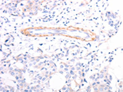 The image on the left is immunohistochemistry of paraffin-embedded Human breast cancer tissue using TPM1 Antibody(TPM1 Antibody) at dilution 1/40, on the right is treated with fusion protein. (Original magnification: ×200)Rabbit anti-Human TPM1 Polyclonal Antibody