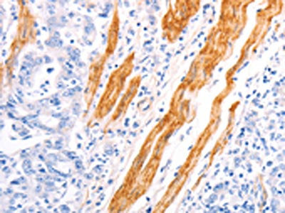 The image on the left is immunohistochemistry of paraffin-embedded Human gastric cancer tissue using the antibody Antibody) at dilution 1/40, on the right is treated with fusion protein. (Original magnification: ×200)Rabbit anti-Human TPM1 Polyclonal Antibody