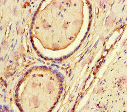Immunohistochemistry of paraffin-embedded human prostate cancer using CFL1 Antibody at dilution of 1:100Rabbit anti-Human CFL1 Polyclonal Antibody