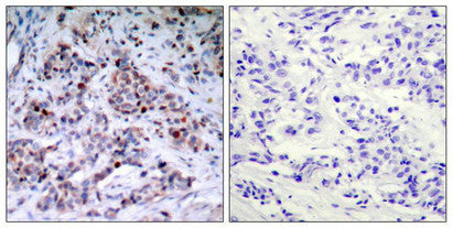Immunohistochemical analysis of paraffin-embedded human breast carcinoma tissue using NF-kB p65(phospho-Thr435) antibody.Rabbit anti-Human RELA Polyclonal Antibody