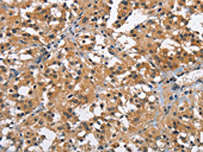 The image on the left is immunohistochemistry of paraffin-embedded Human thyroid cancer tissue using BRE Antibody(BRE Antibody) at dilution 1/40, on the right is treated with fusion protein. (Original magnification: ×200)
