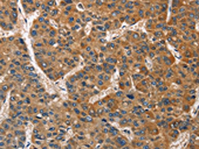 The image on the left is immunohistochemistry of paraffin-embedded Human liver cancer tissue using the antibody Antibody) at dilution 1/40, on the right is treated with fusion protein. (Original magnification: ×200)