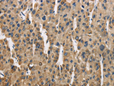 The image is immunohistochemistry of paraffin-embedded Human liver cancer tissue using COX6B1 Antibody(COX6B1 Antibody) at dilution 1/50. (Original magnification: ×200)Rabbit anti-Human COX6B1 Polyclonal Antibody