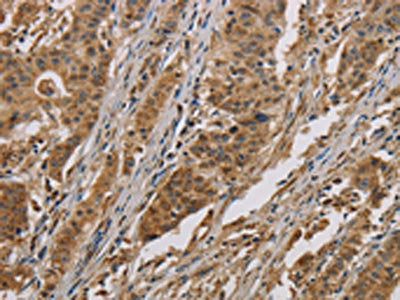 The image on the left is immunohistochemistry of paraffin-embedded Human gastic cancer tissue using the antibody Antibody) at dilution 1/50, on the right is treated with fusion protein. (Original magnification: ×200)Rabbit anti-Human COX6B1 Polyclonal Antibody