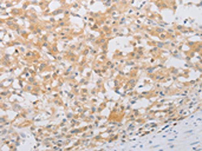 The image on the left is immunohistochemistry of paraffin-embedded Human thyroid cancer tissue using PDE4D Antibody(PDE4D Antibody) at dilution 1/20, on the right is treated with fusion protein. (Original magnification: ×200)Rabbit anti-Human PDE4D Polyclonal Antibody
