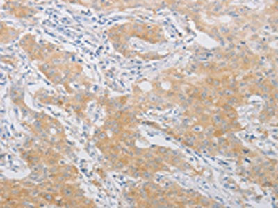 The image on the left is immunohistochemistry of paraffin-embedded Human gastic cancer tissue using the antibody Antibody) at dilution 1/20, on the right is treated with fusion protein. (Original magnification: ×200)Rabbit anti-Human PDE4D Polyclonal Antibody