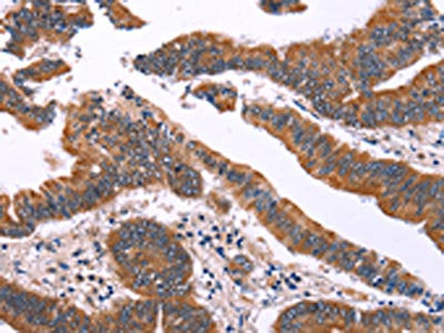 The image on the left is immunohistochemistry of paraffin-embedded Human colon cancer tissue using the antibody Antibody) at dilution 1/40, on the right is treated with fusion protein. (Original magnification: ×200)