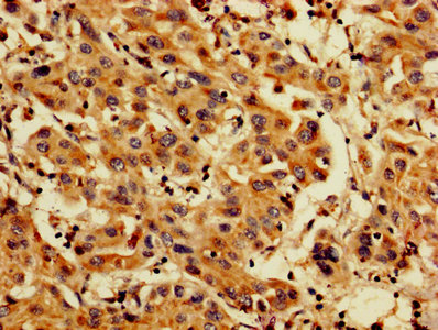 IHC image of the antibody diluted at 1:200 and staining in paraffin-embedded human liver cancer performed on a Leica BondTM system. After dewaxing and hydration, antigen retrieval was mediated by high pressure in a citrate buffer (pH 6.0). Section was blocked with 10% normal goat serum 30min at RT. Then primary antibody (1% BSA) was incubated at 4°C overnight. The primary is detected by a biotinylated secondary antibody and visualized using an HRP conjugated SP system.Rabbit anti-Human PDCD6 Polyclonal Antibody