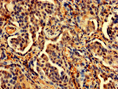 IHC image of PDCD6 Antibody diluted at 1:200 and staining in paraffin-embedded human lung cancer performed on a Leica BondTM system. After dewaxing and hydration, antigen retrieval was mediated by high pressure in a citrate buffer (pH 6.0). Section was blocked with 10% normal goat serum 30min at RT. Then primary antibody (1% BSA) was incubated at 4°C overnight. The primary is detected by a biotinylated secondary antibody and visualized using an HRP conjugated SP system.Rabbit anti-Human PDCD6 Polyclonal Antibody