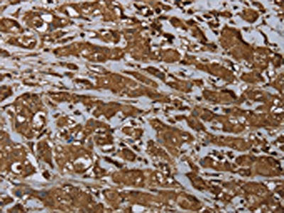 The image on the left is immunohistochemistry of paraffin-embedded Human breast cancer tissue using ARHGDIA Antibody(ARHGDIA Antibody) at dilution 1/30, on the right is treated with fusion protein. (Original magnification: ×200)Rabbit anti-Human ARHGDIA Polyclonal Antibody