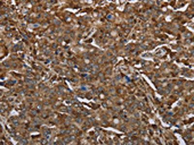 The image on the left is immunohistochemistry of paraffin-embedded Human liver cancer tissue using the antibody Antibody) at dilution 1/30, on the right is treated with fusion protein. (Original magnification: ×200)Rabbit anti-Human ARHGDIA Polyclonal Antibody