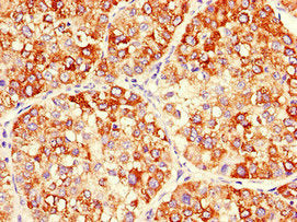 Immunohistochemistry of paraffin-embedded human liver cancer using MAP2K2 Antibody at dilution of 1:100