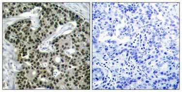 Immunohistochemical analysis of paraffin-embedded human breast carcinoma tissue using HSF1(Phospho-Ser303) Antibody(left) or the same antibody preincubated with blocking peptide(right).Rabbit anti-Human HSF1 Polyclonal Antibody