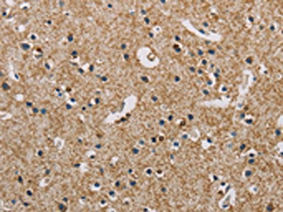 The image on the left is immunohistochemistry of paraffin-embedded Human brain  tissue using PIP4K2A Antibody(PIP4K2A Antibody) at dilution 1/50, on the right is treated with fusion protein. (Original magnification: ×200)Rabbit anti-Human PIP4K2A Polyclonal Antibody