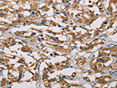 The image on the left is immunohistochemistry of paraffin-embedded Human thyroid cancer tissue using the antibody Antibody) at dilution 1/50, on the right is treated with fusion protein. (Original magnification: ×200)Rabbit anti-Human PIP4K2A Polyclonal Antibody