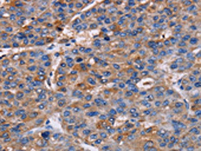 The image on the left is immunohistochemistry of paraffin-embedded Human liver cancer tissue using NPM3 Antibody(NPM3 Antibody) at dilution 1/60, on the right is treated with fusion protein. (Original magnification: ×200)Rabbit anti-Human NPM3 Polyclonal Antibody