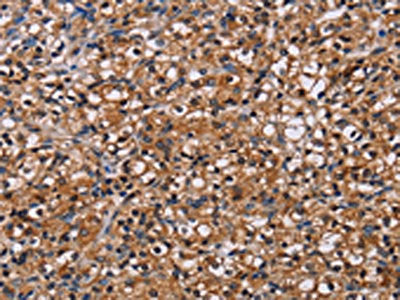 The image on the left is immunohistochemistry of paraffin-embedded Human prostate cancer tissue using the antibody Antibody) at dilution 1/60, on the right is treated with fusion protein. (Original magnification: ×200)Rabbit anti-Human NPM3 Polyclonal Antibody