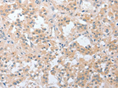 The image on the left is immunohistochemistry of paraffin-embedded Human thyroid cancer tissue using the antibody Antibody) at dilution 1/20, on the right is treated with fusion protein. (Original magnification: ×200)