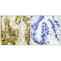 Immunohistochemical analysis of paraffin-embedded human lung carcinoma tissue using Galectin 3 antibody.