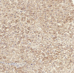 Immunohistochemical analysis of paraffin-embedded Human-liver tissue. 1,TGFβ RI (phospho Ser165) Polyclonal Antibody was diluted at 1:200(4°C,overnight). 2, Sodium citrate pH 6.0 was used for antibody retrieval(>98°C,20min). 3,Secondary antibody was diluted at 1:200(room temperature, 30min).Rabbit anti-Human Phospho-TGFBR1 (S165) Polyclonal Antibody