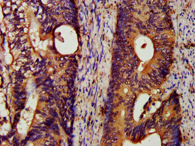 IHC image of HSPA5 Antibody diluted at 1:200 and staining in paraffin-embedded human colon cancer performed on a Leica BondTM system. After dewaxing and hydration, antigen retrieval was mediated by high pressure in a citrate buffer (pH 6.0). Section was blocked with 10% normal goat serum 30min at RT. Then primary antibody (1% BSA) was incubated at 4°C overnight. The primary is detected by a biotinylated secondary antibody and visualized using an HRP conjugated SP system.Rabbit anti-Human HSPA5 Polyclonal Antibody