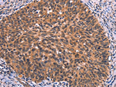 The image on the left is immunohistochemistry of paraffin-embedded Human cervical cancer tissue using FAIM Antibody(FAIM Antibody) at dilution 1/25, on the right is treated with synthetic peptide. (Original magnification: ×200)Rabbit anti-Human FAIM Polyclonal Antibody