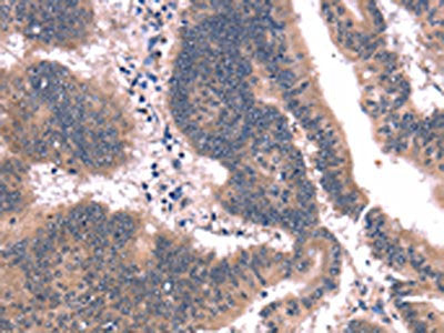The image on the left is immunohistochemistry of paraffin-embedded Human colon cancer tissue using the antibody Antibody) at dilution 1/25, on the right is treated with synthetic peptide. (Original magnification: ×200)Rabbit anti-Human FAIM Polyclonal Antibody