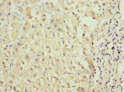 Immunohistochemistry of paraffin-embedded human liver cancer using TMED2 Antibody at dilution of 1:100Rabbit anti-Human TMED2 Polyclonal Antibody