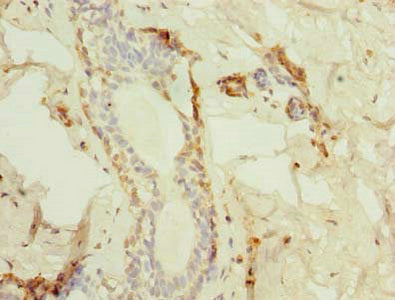 Immunohistochemistry of paraffin-embedded human breast cancer using TMED2 Antibody at dilution of 1:100Rabbit anti-Human TMED2 Polyclonal Antibody