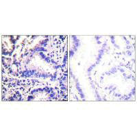 Immunohistochemical analysis of paraffin-embedded human lung carcinoma tissue using Synuclein γ antibody.Rabbit anti-Human SNCG Polyclonal Antibody