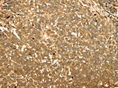The image on the left is immunohistochemistry of paraffin-embedded Human ovarian cancer tissue using RAB26 Antibody(RAB26 Antibody) at dilution 1/60, on the right is treated with synthetic peptide. (Original magnification: ×200)Rabbit anti-Human RAB26 Polyclonal Antibody