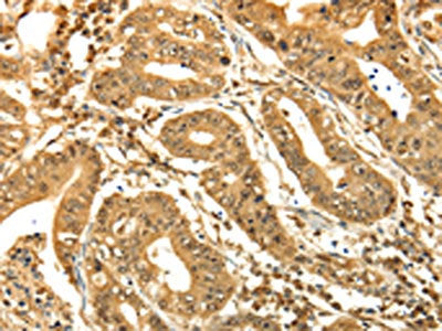 The image on the left is immunohistochemistry of paraffin-embedded Human gastic cancer tissue using the antibody Antibody) at dilution 1/60, on the right is treated with synthetic peptide. (Original magnification: ×200)Rabbit anti-Human RAB26 Polyclonal Antibody