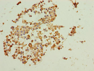 Immunohistochemistry of paraffin-embedded human breast cancer using BTBD2 Antibody at dilution of 1:100